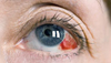 Eye Diseases