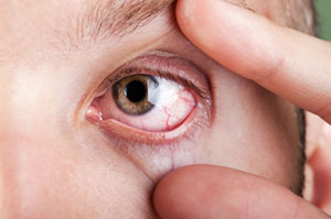 Eye Diseases